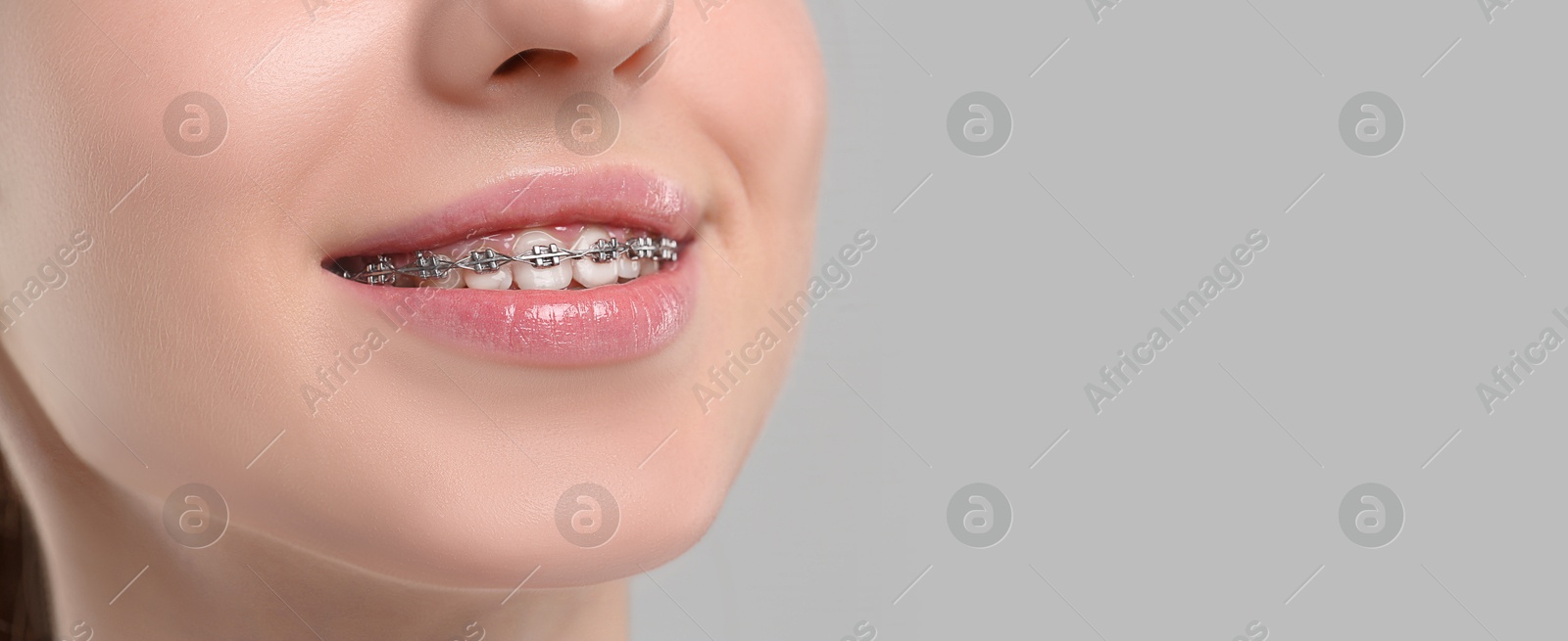 Image of Woman with braces smiling on light background, closeup. Banner design with space for text