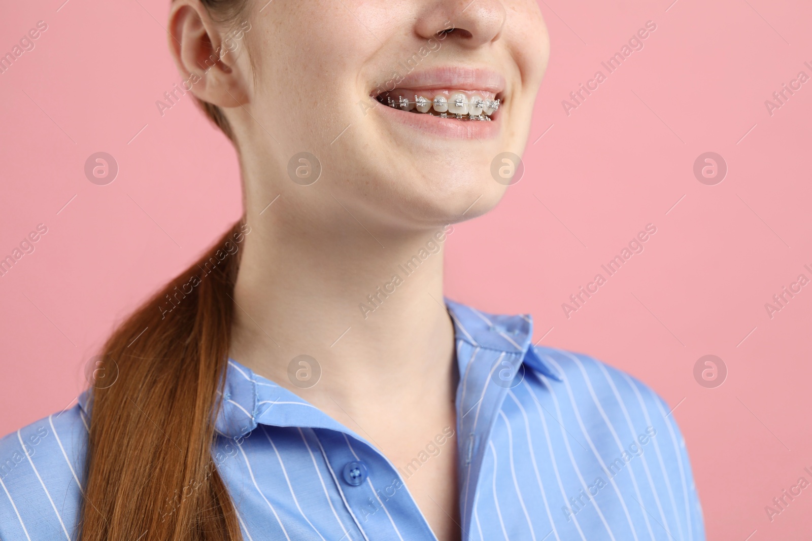 Photo of Girl with braces on pink background, closeup