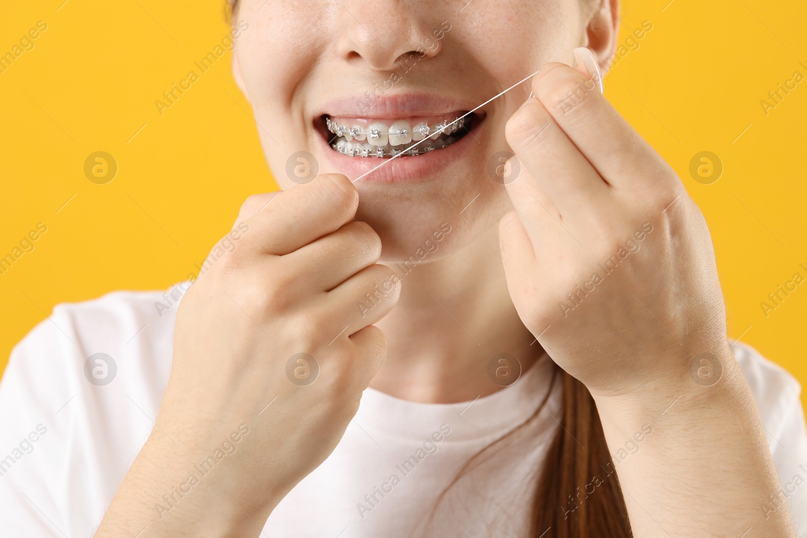 Photo of Girl with braces cleaning teeth with dental floss on orange background, closeup