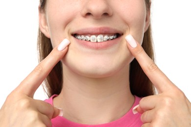 Photo of Girl pointing at her braces on white background, closeup