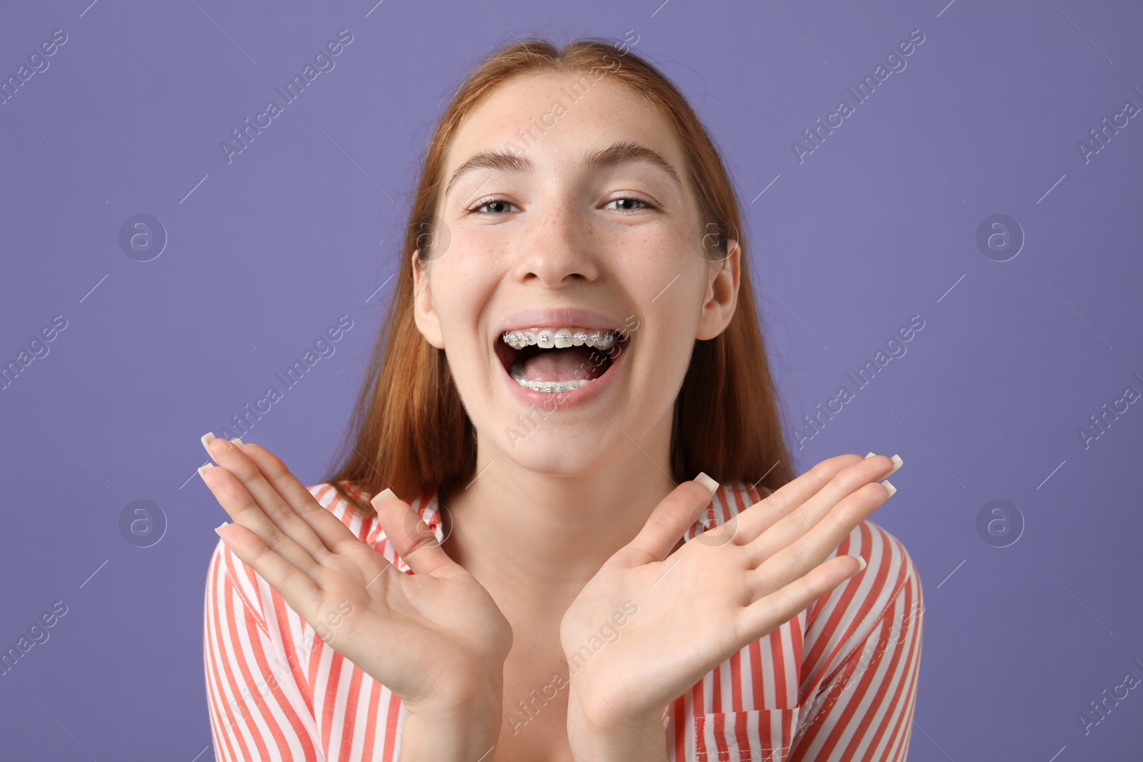 Photo of Smiling girl with braces on purple background