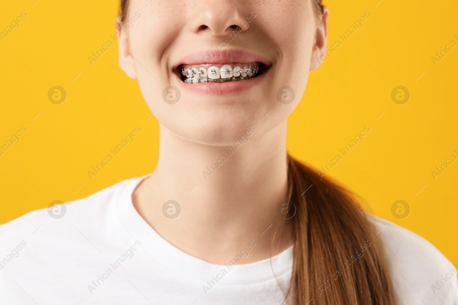 Photo of Girl with braces on orange background, closeup