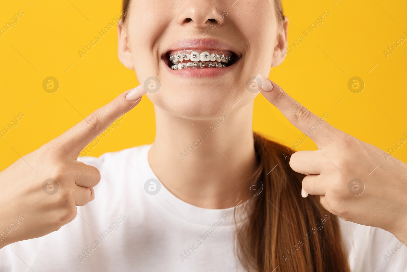 Photo of Girl pointing at her braces on orange background, closeup