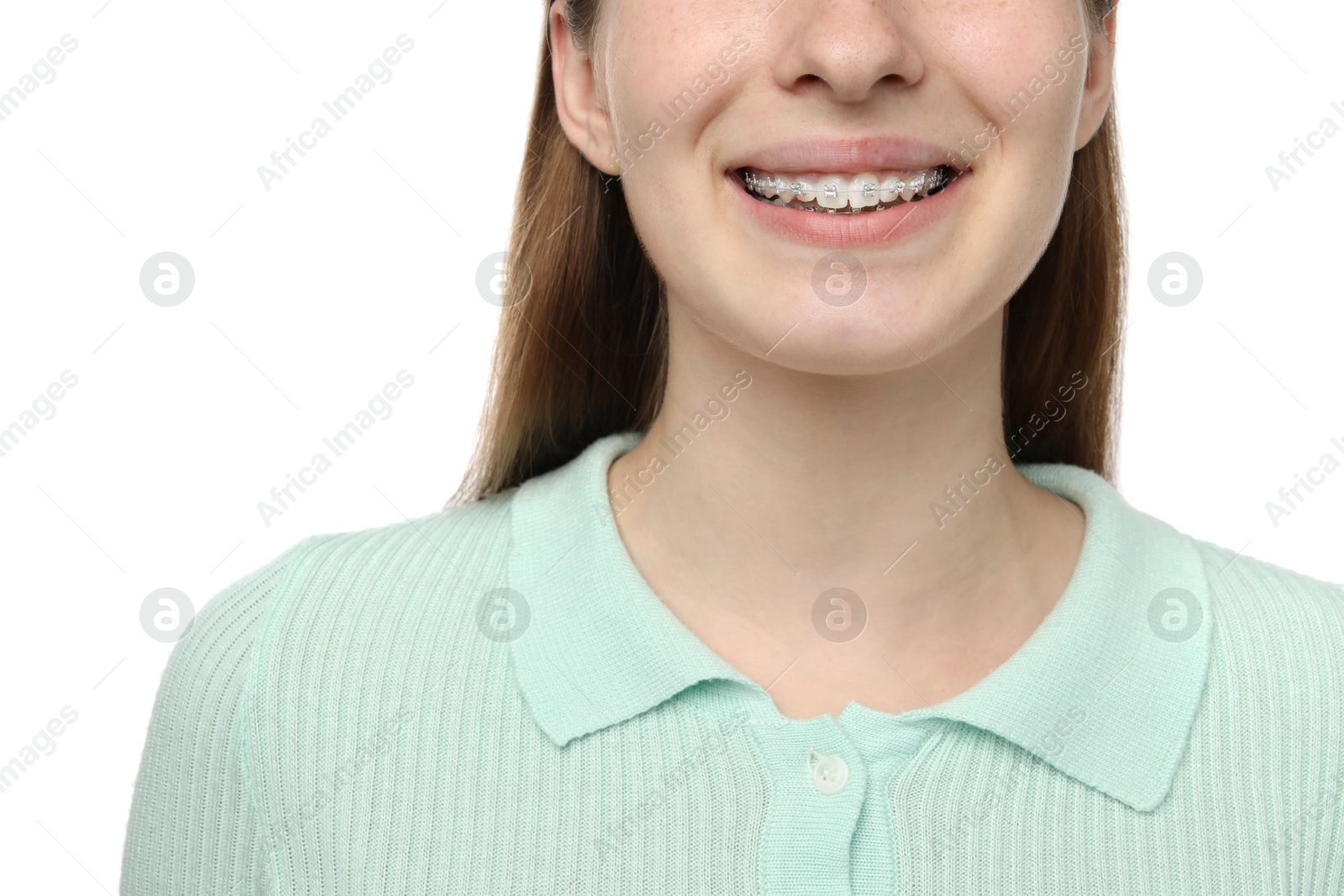 Photo of Girl with braces on white background, closeup