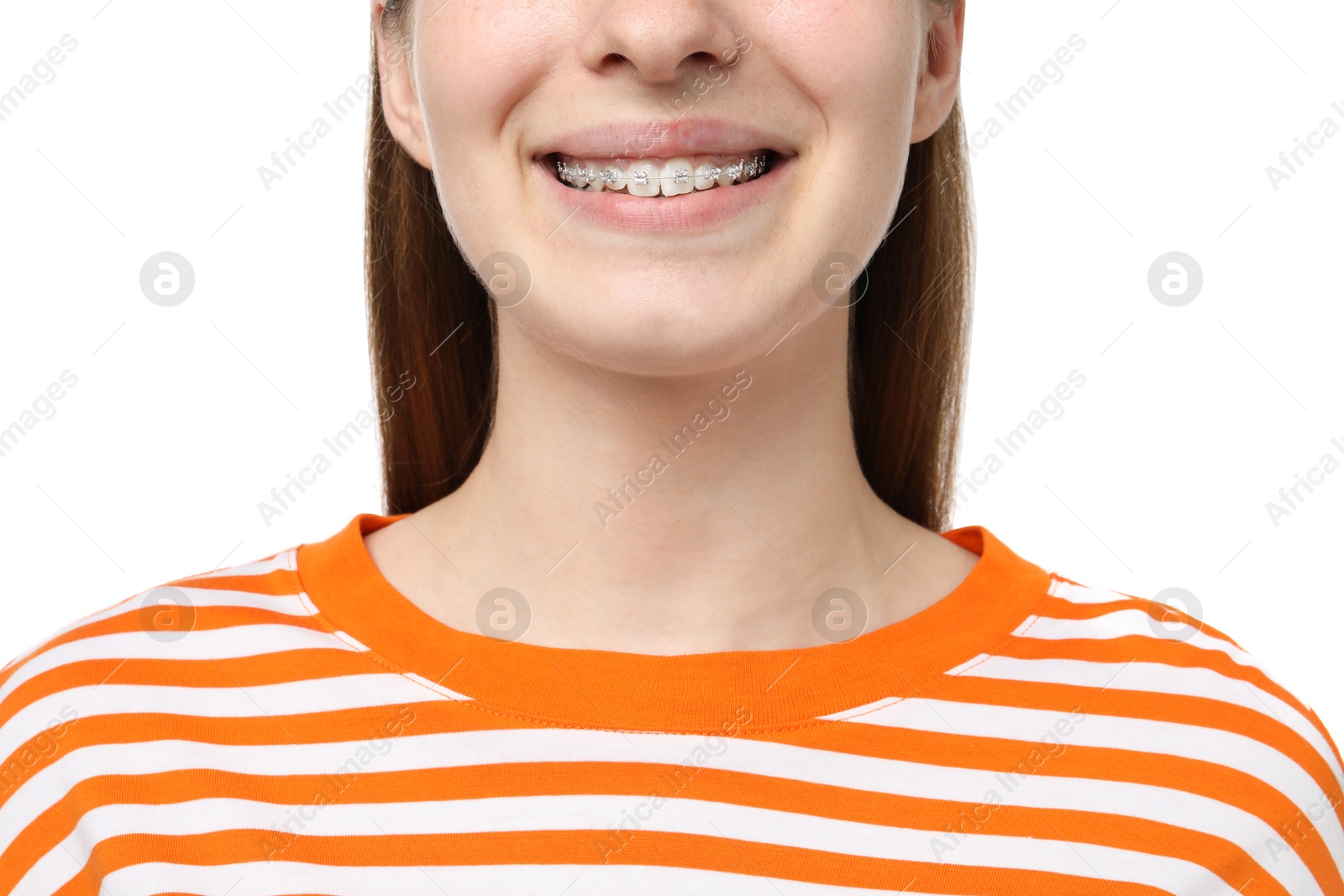 Photo of Girl with braces on white background, closeup