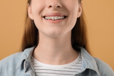 Photo of Girl with braces on beige background, closeup