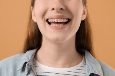 Photo of Girl with braces on beige background, closeup