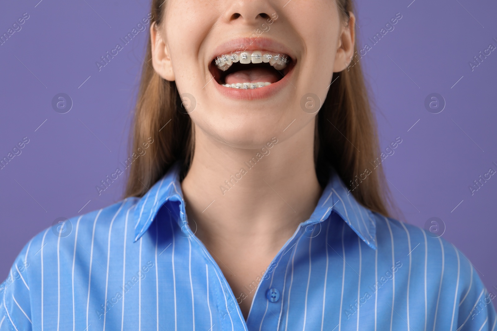 Photo of Girl with braces on purple background, closeup