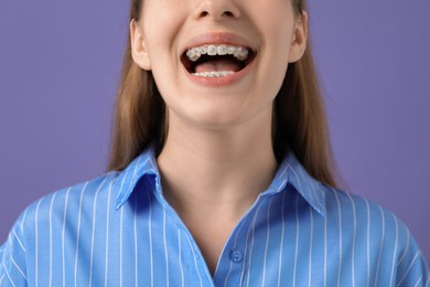 Photo of Girl with braces on purple background, closeup