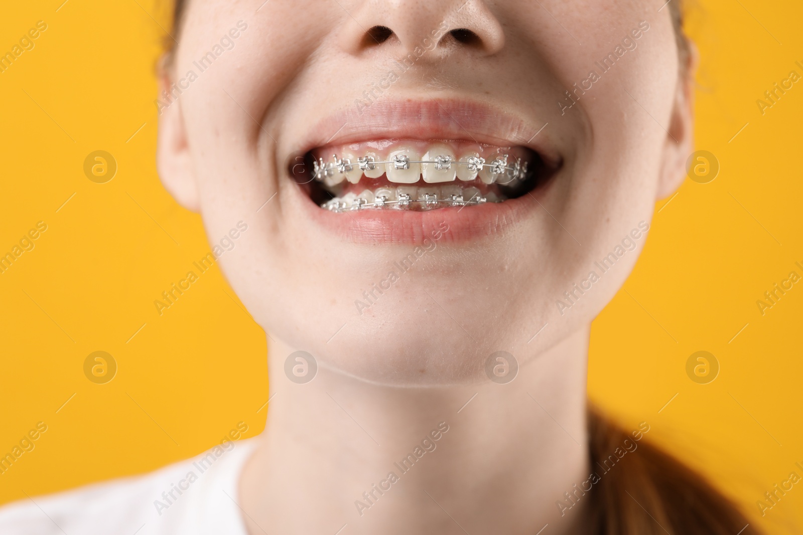 Photo of Girl with braces on orange background, closeup