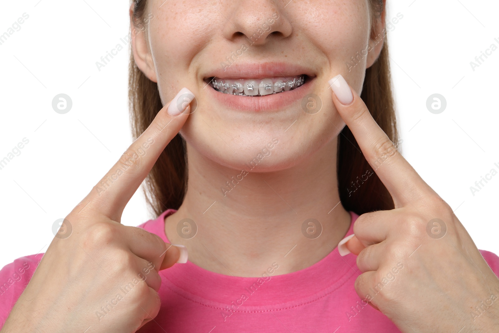 Photo of Girl pointing at her braces on white background, closeup