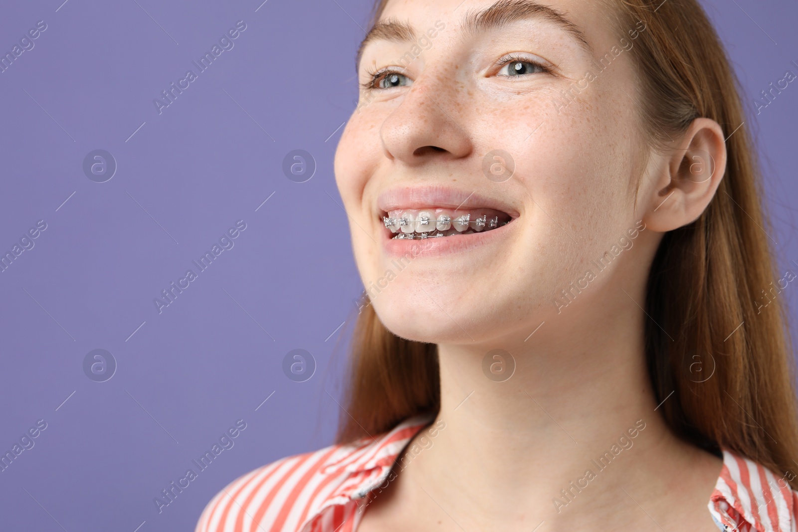 Photo of Smiling girl with braces on purple background, space for text