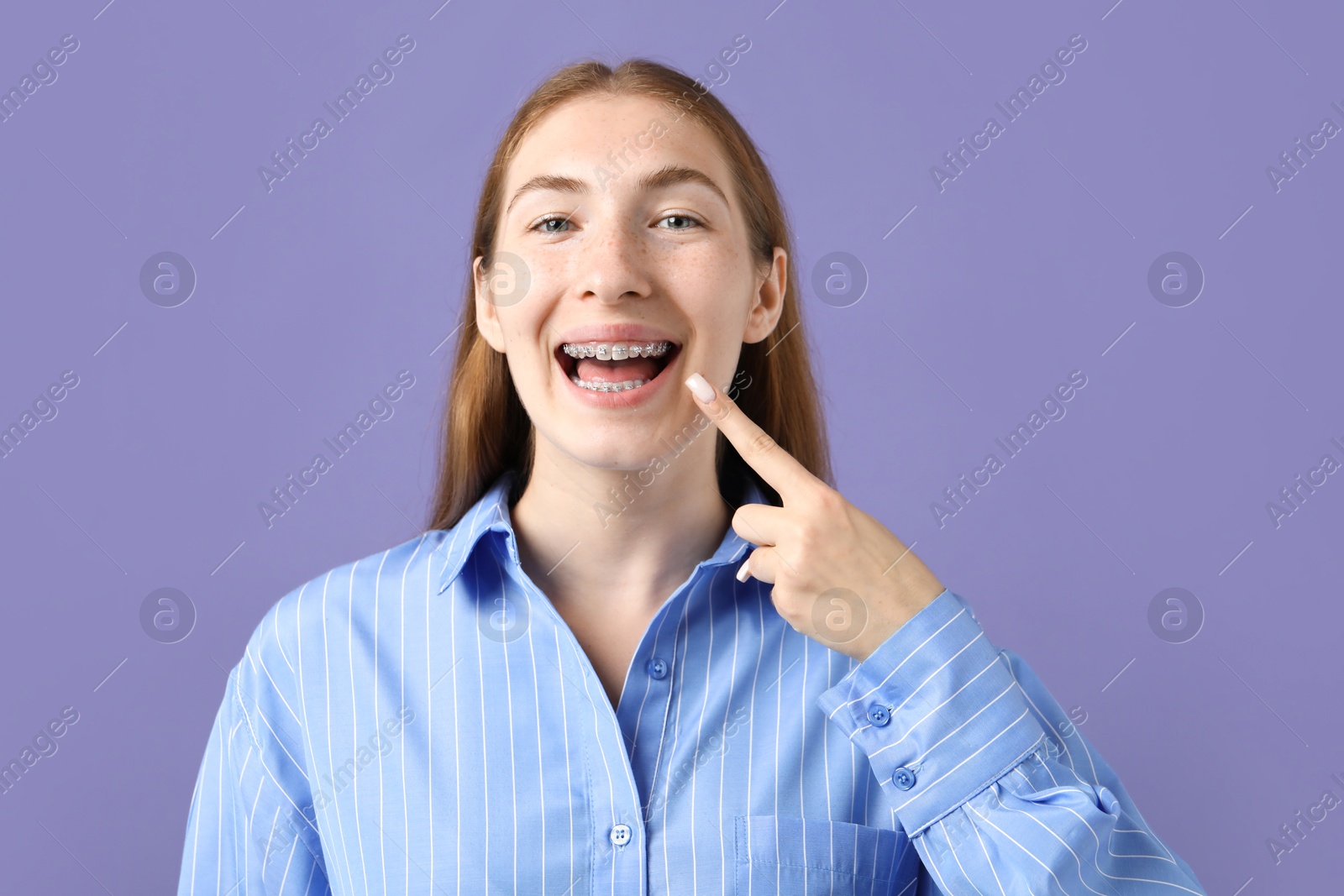 Photo of Girl pointing at her braces on purple background