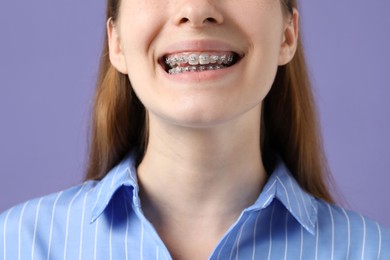 Photo of Girl with braces on purple background, closeup