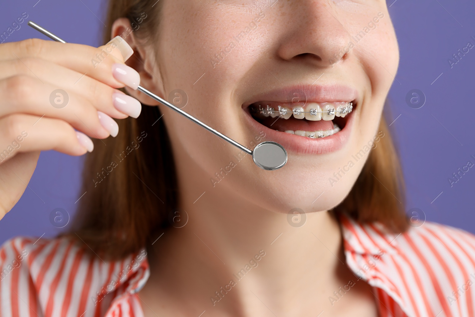 Photo of Girl with braces using dental mirror on purple background, closeup