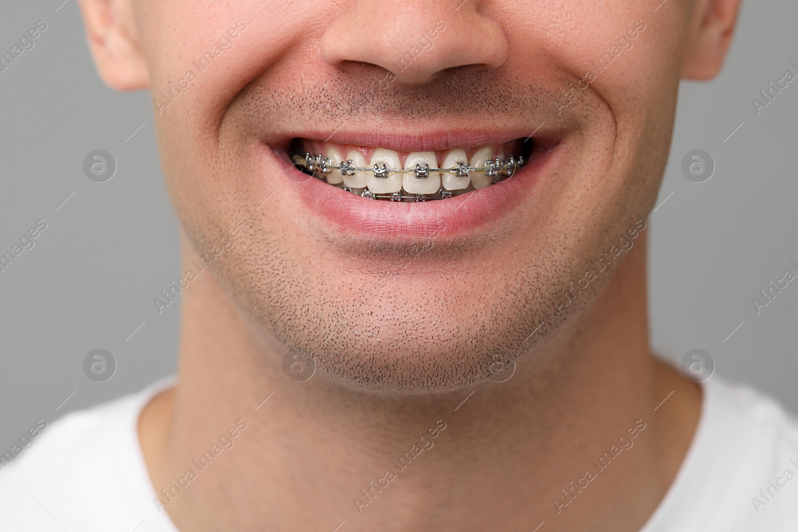 Photo of Smiling man with dental braces on grey background, closeup