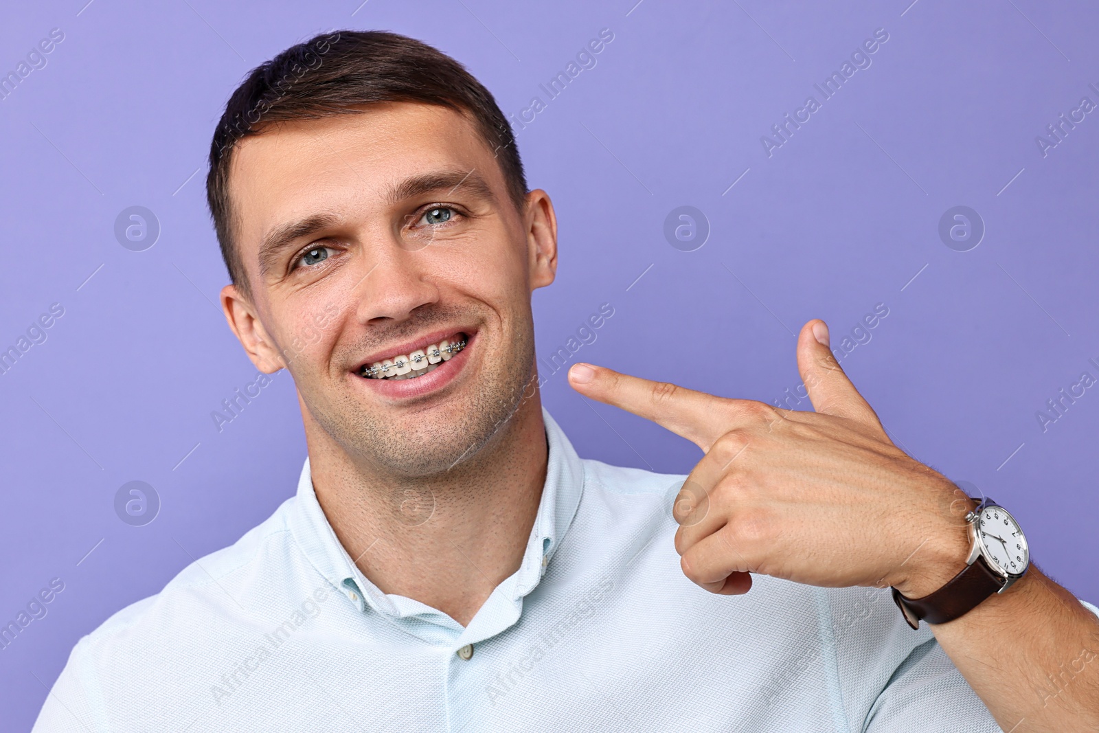 Photo of Happy man pointing at his dental braces on violet background