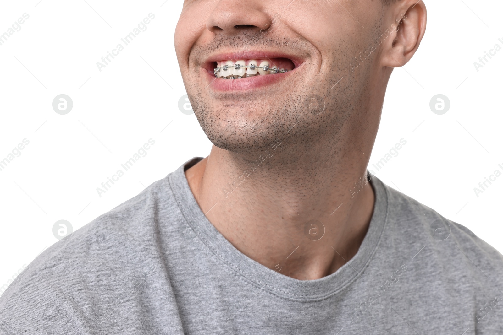 Photo of Smiling man with dental braces on white background, closeup