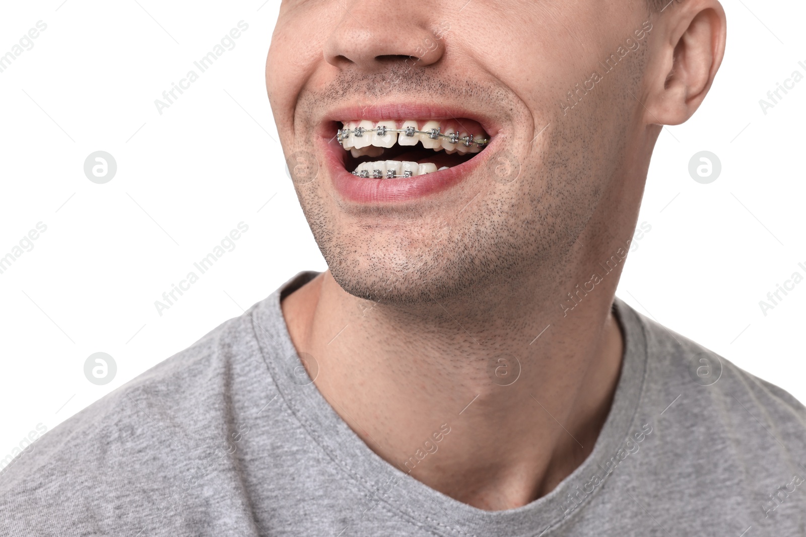 Photo of Happy man with dental braces on white background, closeup