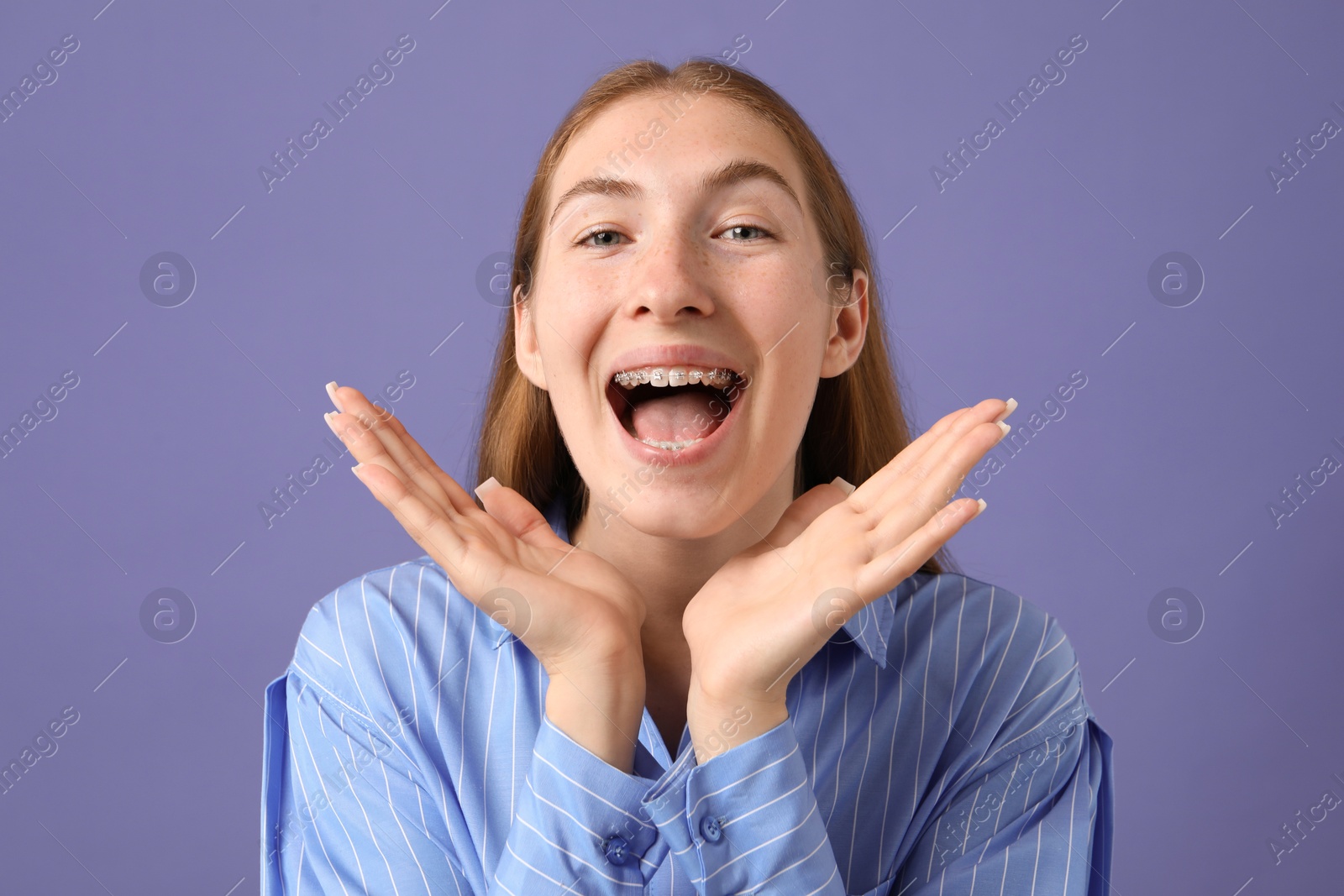 Photo of Smiling girl with braces on purple background