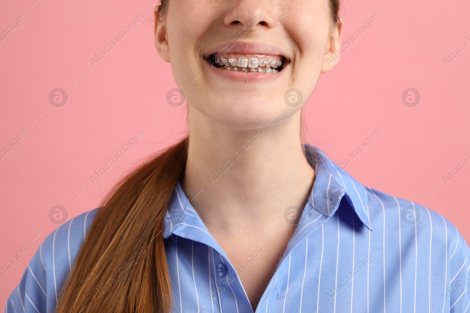 Photo of Girl with braces on pink background, closeup