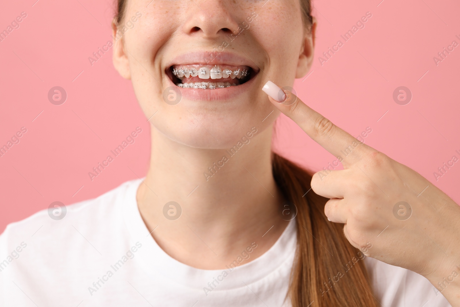 Photo of Girl pointing at her braces on pink background, closeup