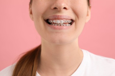 Photo of Girl with braces on pink background, closeup