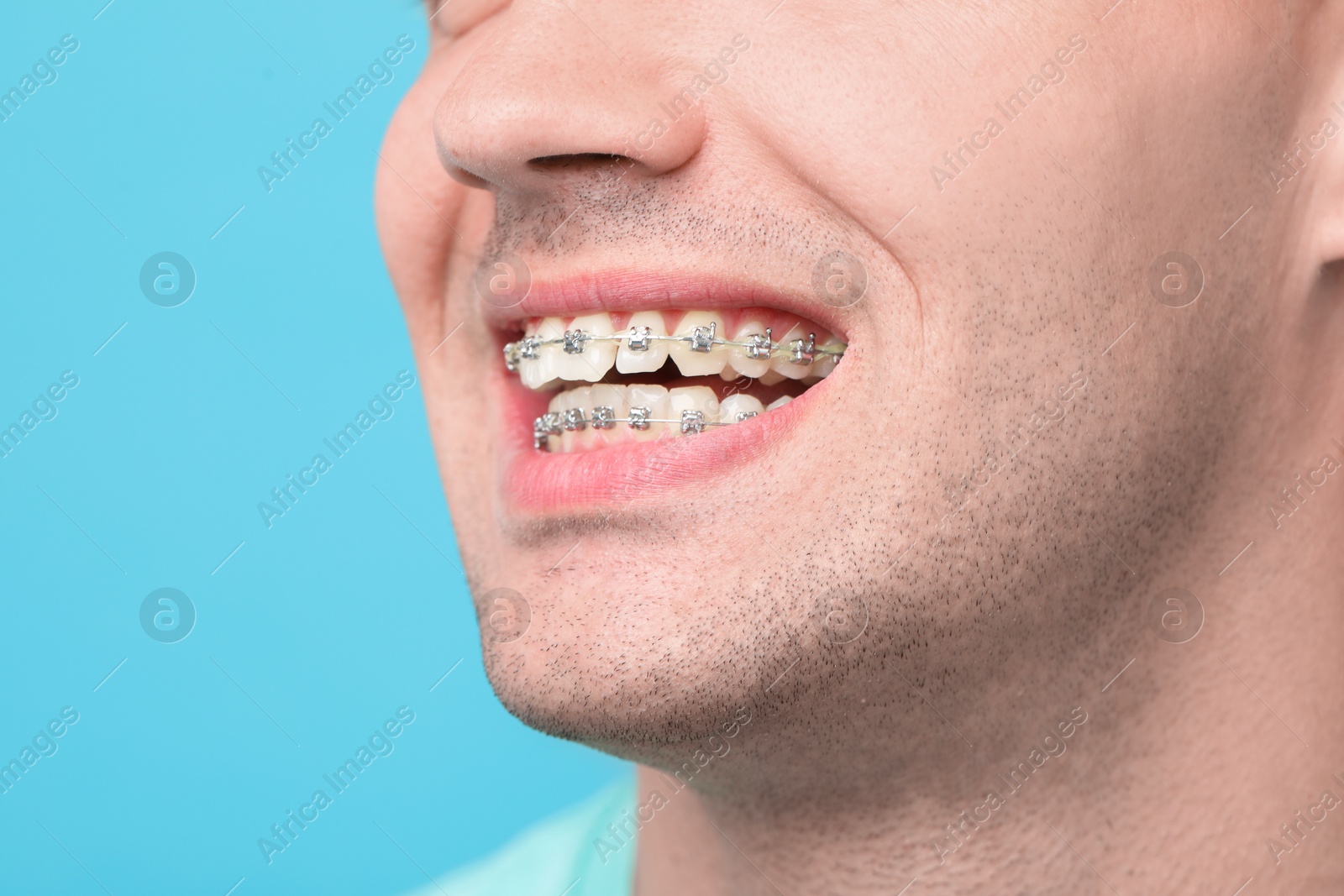 Photo of Man with dental braces on light blue background, closeup