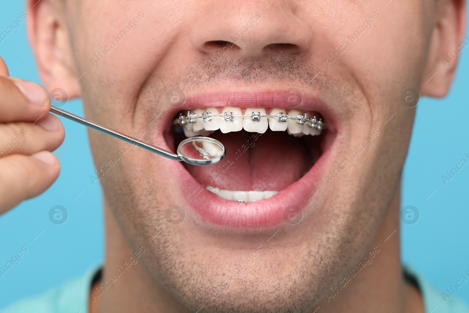 Photo of Examination of man's teeth with braces using mirror tool on light blue background, closeup