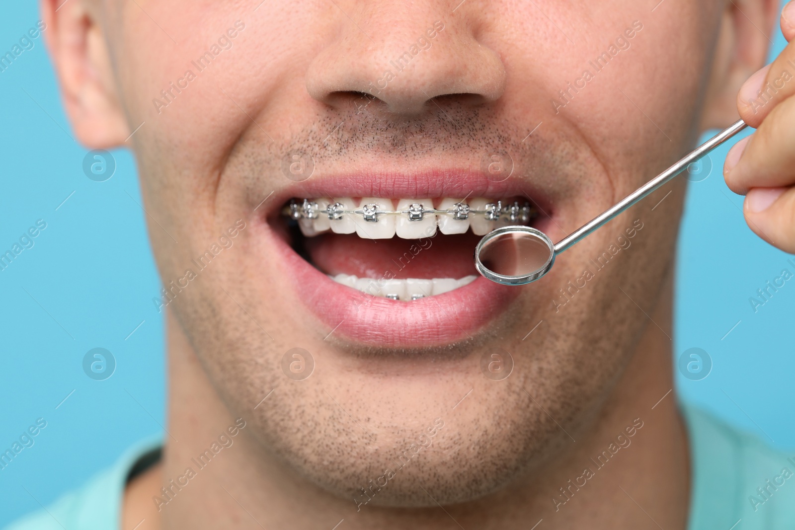 Photo of Examination of man's teeth with braces using mirror tool on light blue background, closeup