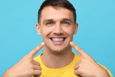 Smiling man pointing at his dental braces on light blue background