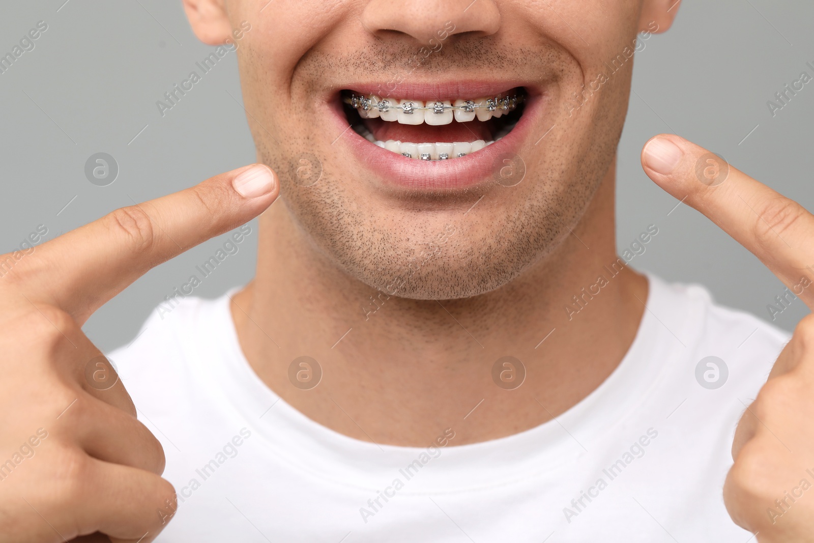 Photo of Smiling man pointing at his dental braces on grey background, closeup