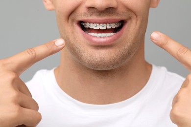 Smiling man pointing at his dental braces on grey background, closeup