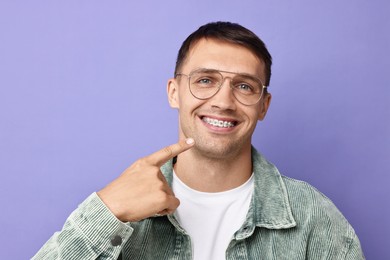 Happy man pointing at his dental braces on violet background