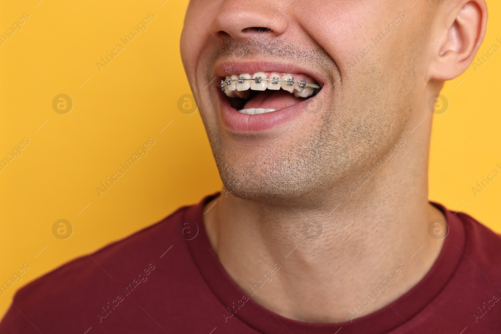 Photo of Happy man with dental braces on yellow background, closeup