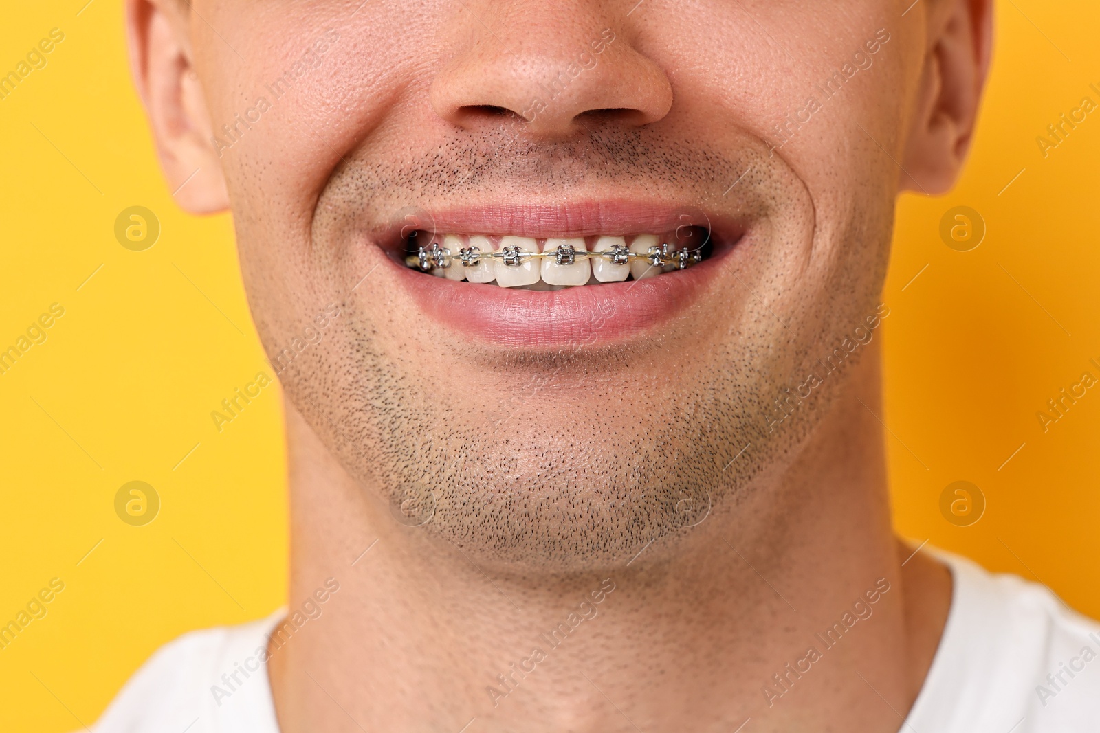 Photo of Smiling man with dental braces on yellow background, closeup