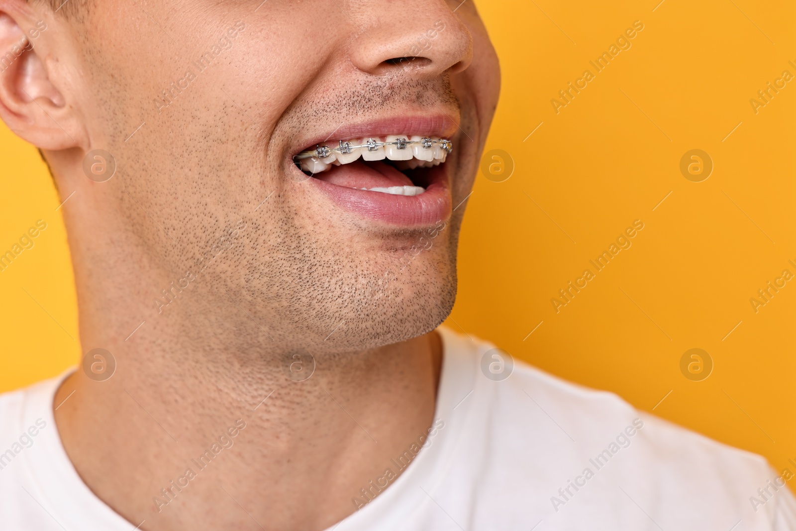 Photo of Happy man with dental braces on yellow background, closeup