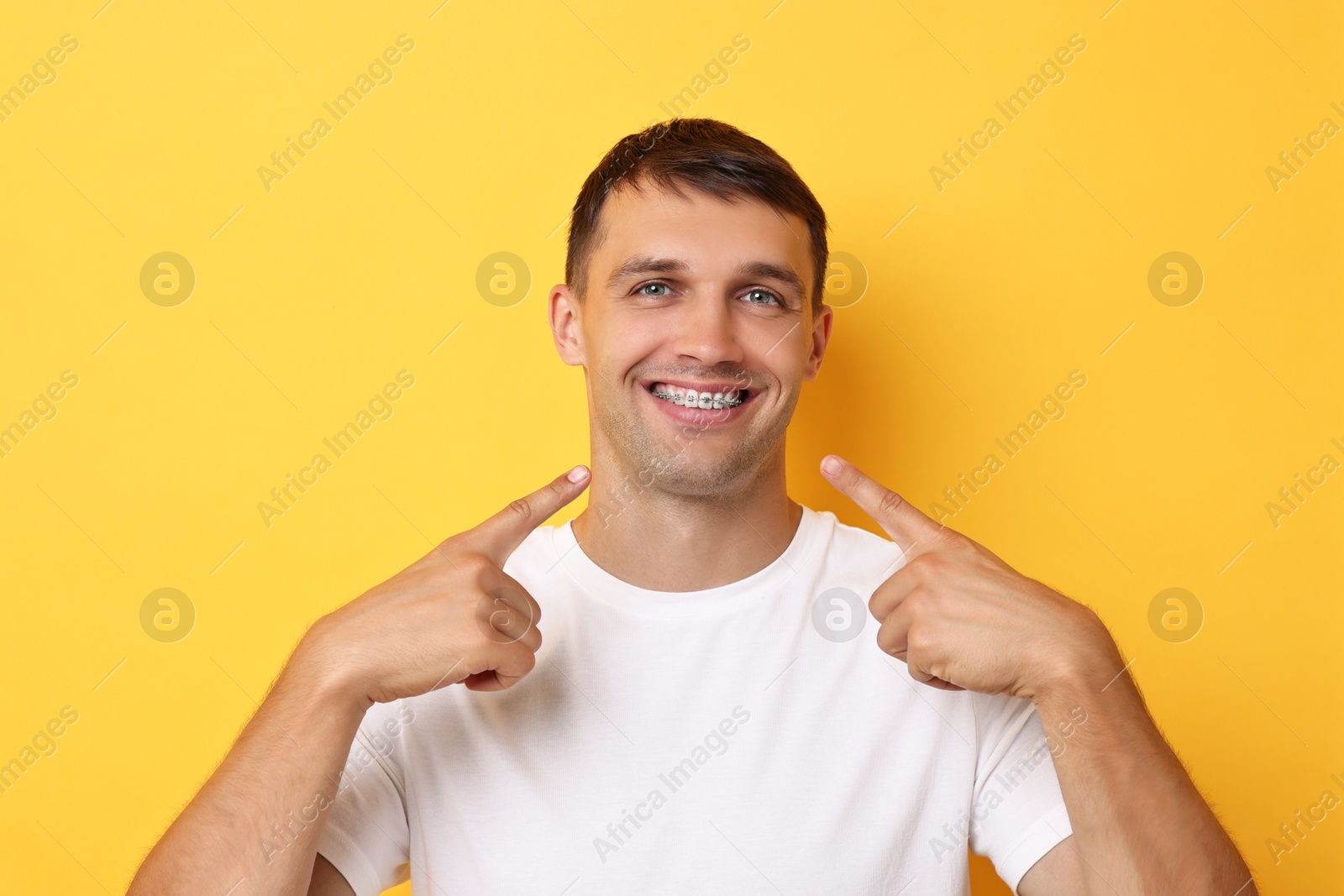 Photo of Smiling man pointing at his dental braces on yellow background