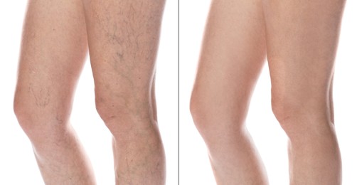 Image of Varicose veins treatment. Woman showing legs on white background, closeup. Before and after collage