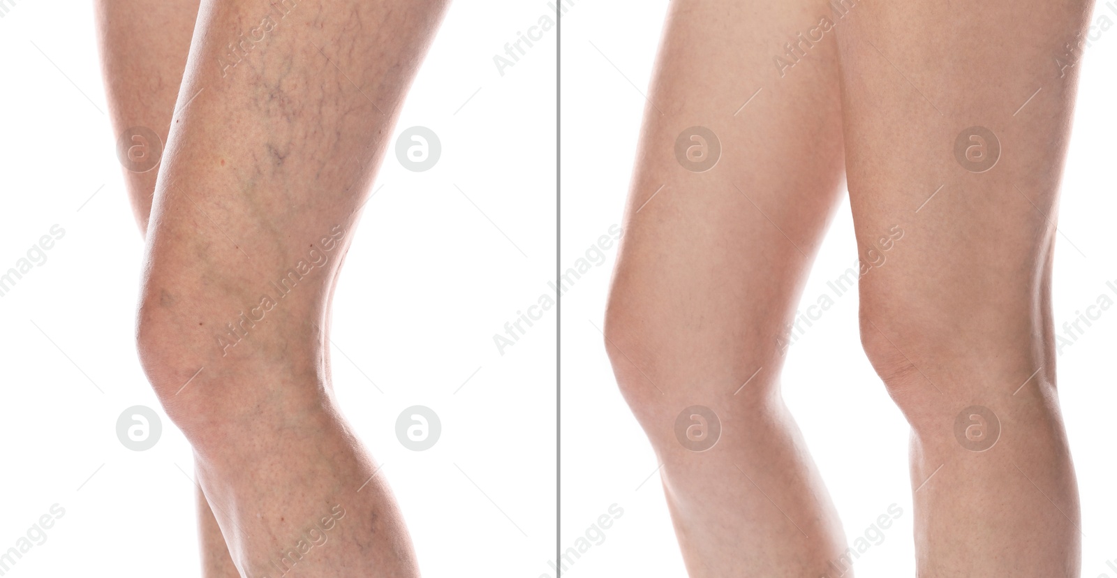 Image of Varicose veins treatment. Woman showing legs on white background, closeup. Before and after collage