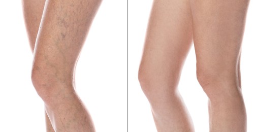 Image of Varicose veins treatment. Woman showing legs on white background, closeup. Before and after collage