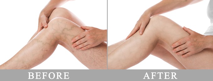 Image of Varicose veins treatment. Woman showing legs on white background, closeup. Before and after collage