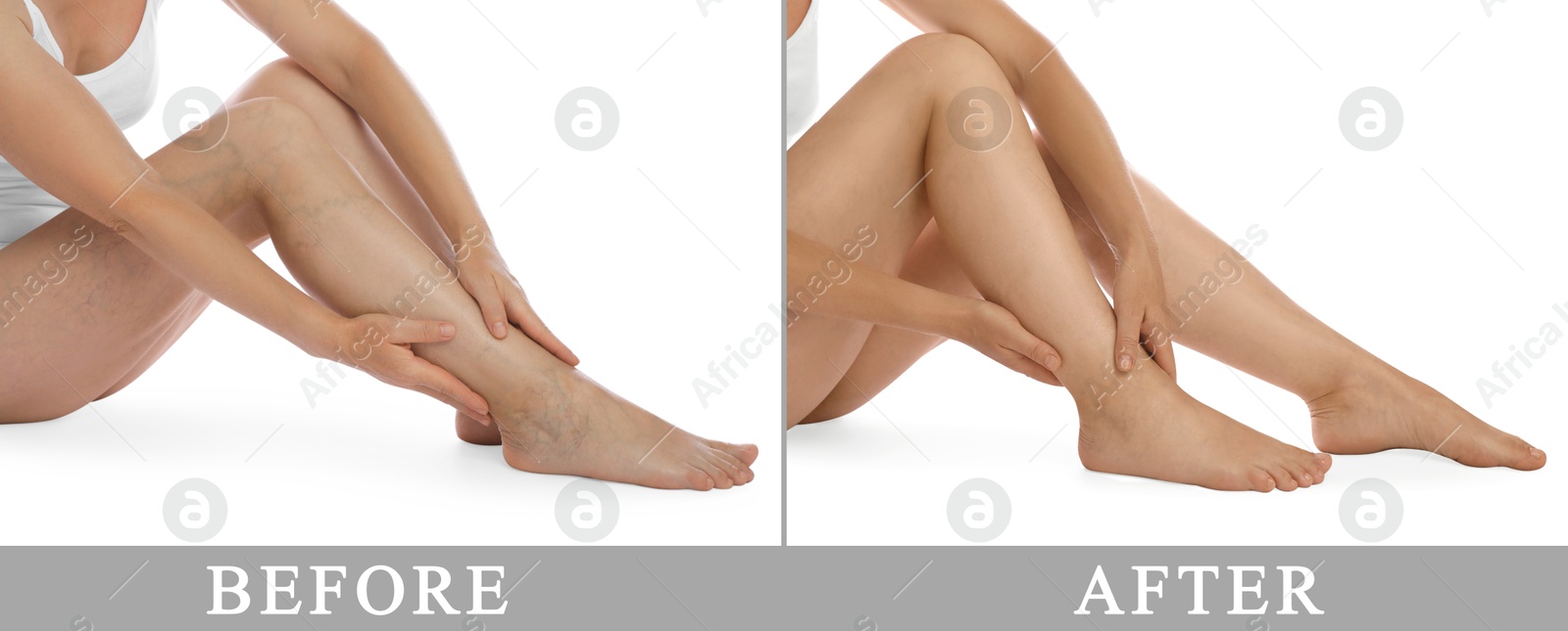 Image of Varicose veins treatment. Woman showing legs on white background, closeup. Before and after collage