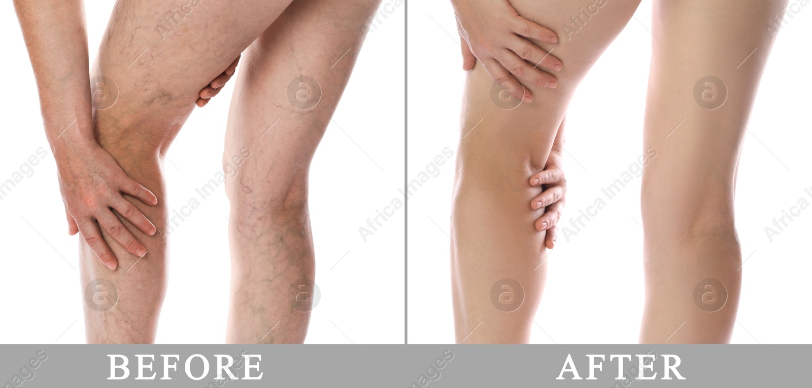 Image of Varicose veins treatment. Woman showing legs on white background, closeup. Before and after collage