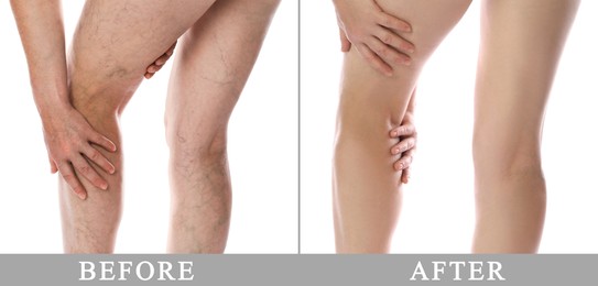 Image of Varicose veins treatment. Woman showing legs on white background, closeup. Before and after collage