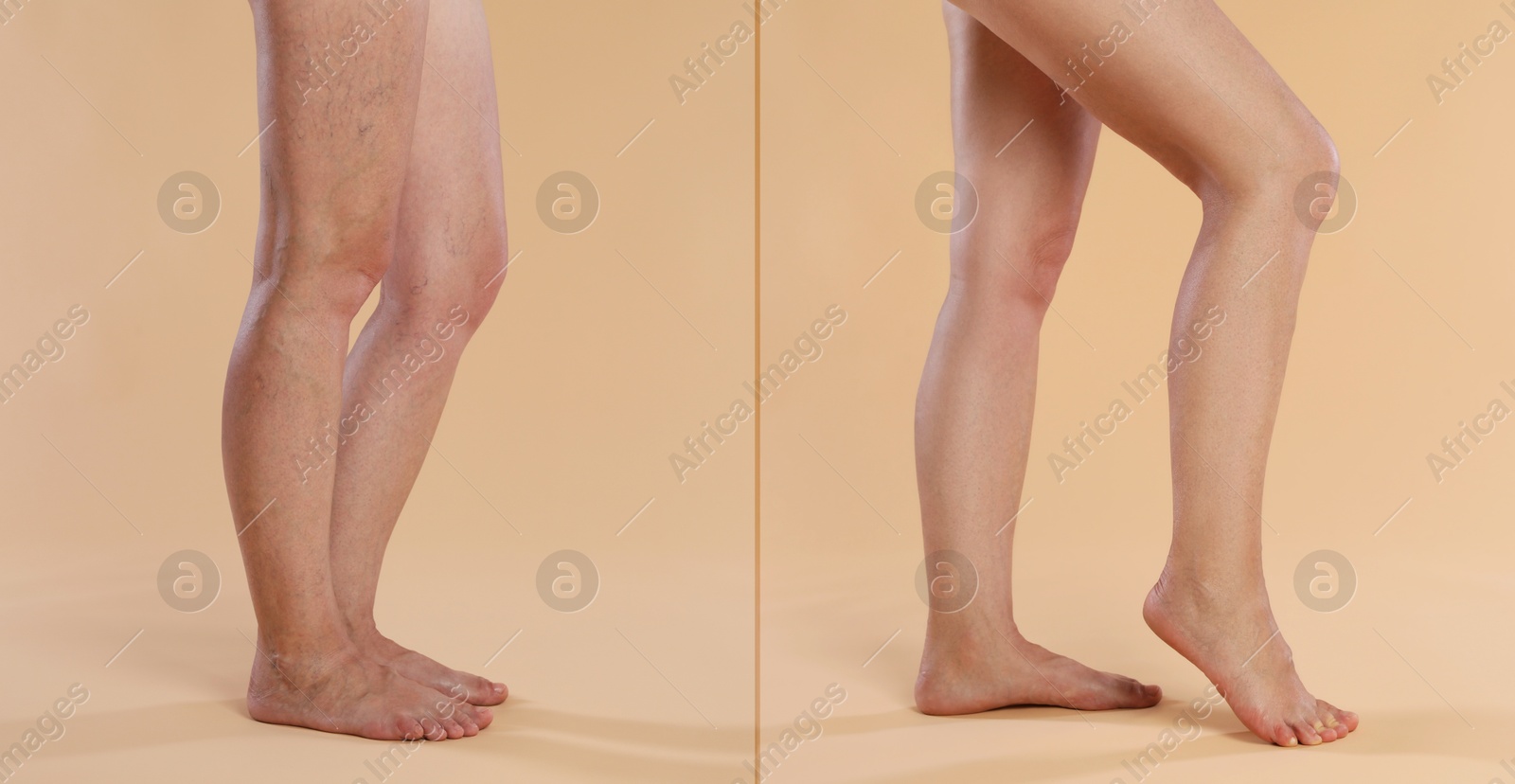 Image of Varicose veins treatment. Woman showing legs on dark beige background, closeup. Before and after collage