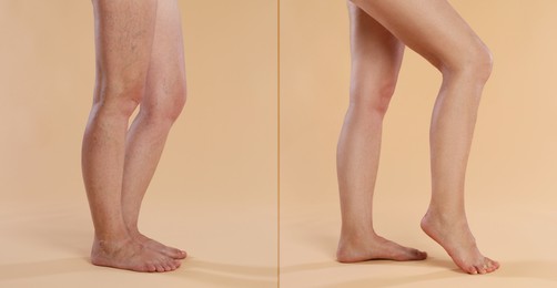 Varicose veins treatment. Woman showing legs on dark beige background, closeup. Before and after collage