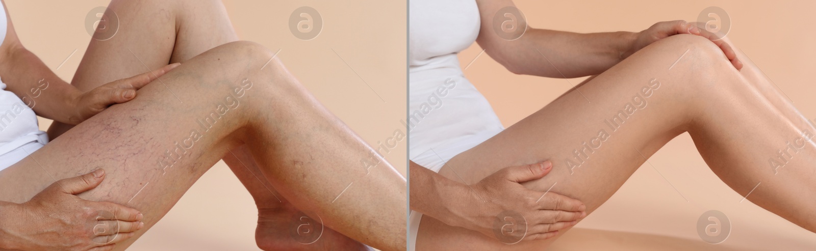 Image of Varicose veins treatment. Woman showing legs on dark beige background, closeup. Before and after collage