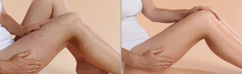 Image of Varicose veins treatment. Woman showing legs on dark beige background, closeup. Before and after collage