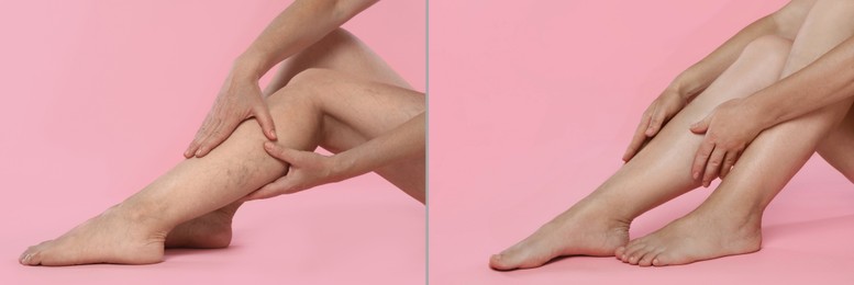 Image of Varicose veins treatment. Woman showing legs on pink background, closeup. Before and after collage